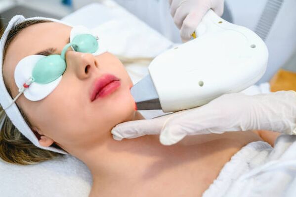 procedimiento de rejuvenecimiento de la piel facial con láser