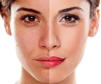cambios en la piel facial después de la exfoliación con láser