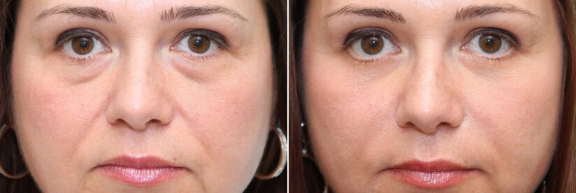 Antes y después de la blefaroplastia eliminación del cuerpo graso debajo de los ojos y estiramiento de la piel