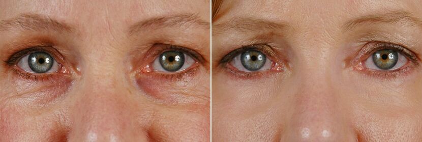 Antes y después de la cirugía láser rejuvenecimiento de la piel alrededor de los ojos