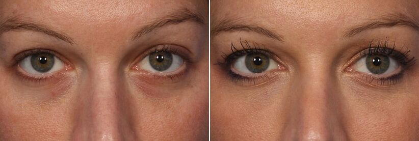 Antes y después del uso de rellenos inyectables - reducción de ojeras